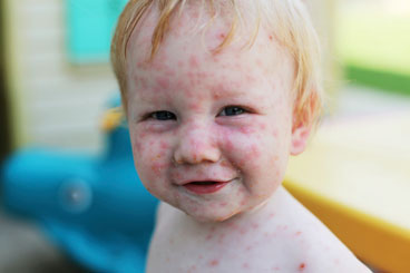 boy with chicken pox